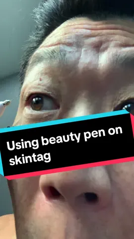 Using the beauty pen on a skin tag removal #skintagsremoval #wart #mole #tattoo #beauty 