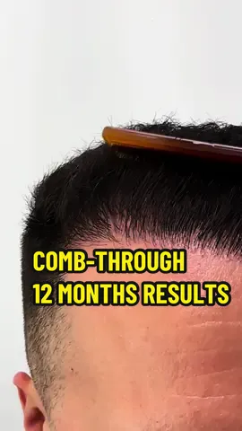 WATCH THE FULL COMB-THROUGH 12 MONTHS RESULT VIDEO OF A HAIR TRANSPLANT PATIENT Watch the incredible hair transformation unfold as our skilled specialist nurse, @ellavoss_ , delicately combs through 12 months of growth on a hair transplant patient’s new, natural looking hairline! This patient had a total of 3000+ hair grafts. Are you ready to transform your hairline and boost your confidence? Book your hair transplant consultation now and discover the life-changing results that await you. Your journey to renewed confidence starts here! For more information contact us or send us a DM. 📍CONTACT INFO www.hairdoctors.com.au Tel (02) 7252 3351 - SYDNEY Tel (03) 9088 0287 - MELBOURNE info@hairdoctors.com.au DISCLAIMER: The results of a hair transplant procedure may vary from person to person. While we strive to provide the best possible outcome, it is important to understand that individual factors such as hair type, density, and overall health can influence the final results. We recommend consulting with a qualified hair transplant specialist to discuss your specific case and expectations. Please note that the information provided here is for general informational purposes only and should not be considered as medical advice. #hairtransplant #hairreplacement #hairrestoration #hairtransformation #hairtransplantation #hairtransplantsurgeon #hairstyle #hairtutorial #hairgoals #hairideas #hairfashion #hairvideo #barber #barberlife #barbershop @Ossman Ashraf 