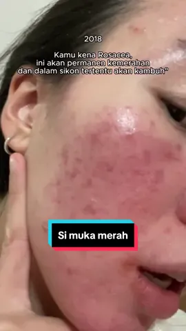 Kalo kambuh langsung mental breakdown, ada yang relate? 😿 #rosacea #skinjourney #fyp #skincaretips #beforeandafter 