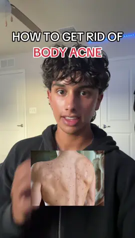 How to get rid of body acne #SelfImprovement #tips #advice #acne #acnetreatment #acneskin #bodyacne #bodyacnetreatment #skin #skincare #skincaretips #SkinCare101 #carbcycling #panoxyl #adapalenegel #harmancheema 