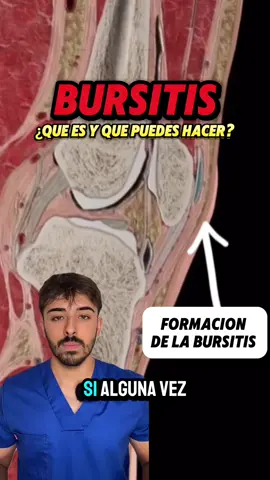 ❗️👇🏽¿QUÉ PUEDES HACER?👇🏽❗️ 👉🏼 El reposo es una opción que debes contemplar pero eso no significa parar. Significa identificar qué es lo que más te molesta y bajar el ritmo en esa actividad. Sin embargo, debes aprovechar todas aquellas actividades que no te molesten y seguir con ellas. 🧊 Aplicar frio sobre la zona te puede ayudar a combatir el dolor. Puedes aplicarlo varias veces al día durante 20 minutos. 🏋🏽 En cuanto a ejercicios, no parece haber ejercicios específicos para esta patología. Lo ideal es volver progresivamente y marcando tiempos a la actividad que queremos recuperar. ❕SIGUEME PARA MÁS ❕ #bursitis #dolor #codo #rodilla #hombro #bulto #anatomia #fisio 