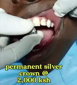 permanent silver crown available at silver line dental clinic nairobi Eastleigh section one second avenue opposite Lillyput house.  #grillzdesign  #silvercrown 