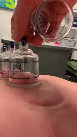 ASMR  #foryou #fyp #drkyleross #sportstherapy #cuppingtherapy #chiropractor #chicago #satisfying  #asmr #oddlfysatisfying #hijama #china #japan #middleeast #dubai #chicago #trypophobia #lollapalooza