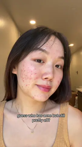 Acne on others always look so pretty 🙂‍↕️ #fyp #viral #relatable #acne #hormonalacne #acnejourney #clearskin 