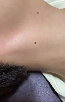 𝐓𝐀̂̉𝐘 𝐍𝐎̂́𝐓 𝐑𝐔𝐎̂̀𝐈 - Đ𝐎̂́𝐓 𝐌𝐔̣𝐍 𝐓𝐇𝐈̣𝐓 - 𝐌𝐔̣𝐍 𝐂𝐎̛𝐌 -  𝐊𝐇𝐎̂𝐍𝐆 Đ𝐀𝐔 -HẠN CHẾ 𝐒𝐄̣𝐎 TỐI ĐA. 👉🏿 Phương pháp đốt nốt ruồi, mụn cơm , mụn thịt bằng phương pháp đốt plasma loại bỏ tận gốc chân nốt ruồi gây mất thẩm mĩ 👉Hiệu quả - an toàn✅ Trước khi thao tác được ủ tê hoàn toàn sẽ không đau✅ Không tác dụng phụ✅ Không tốn thời gian ✅ Không cần nghỉ dưỡng✅  có bảo hành#tẩynốtruồi #đốtnốtruồi #xoánốtruồi #tẩymụnthịt #đốtmụnthịt #tẩymụncóc #đốtmụncóc #nốtruồi( có nhận làm tận nhà).