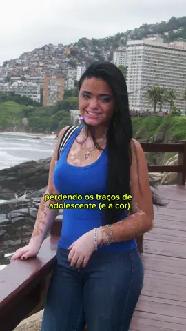 em matéria de mudança eu gabarito com força KKKK #foreveryoung  #vitiligouniversal 