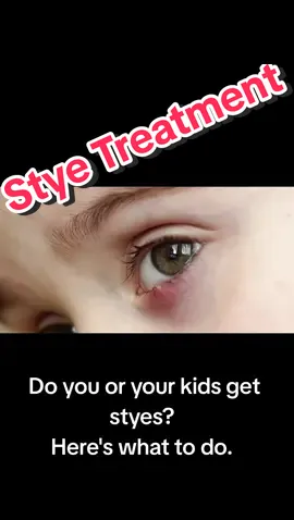Stye treatment #creatorsearchinsights  #skincare #healthtips  #stye 