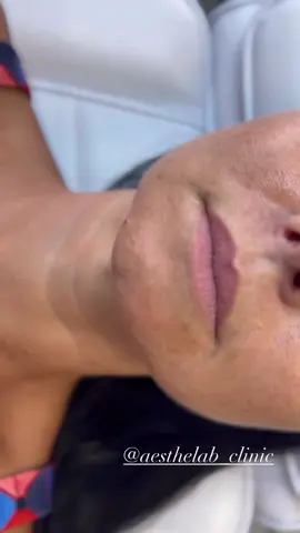Lip filler 💉 AestheLab Clinic 💫 Aesthetics | Injectables | Russian Lips | Endermologie | Jawline Contouring | Tissue Stimulators | Radio Frequency | Stem Cells | Cavi-Lipo | Semi-permanent make-up and more 🪄 📍 27 D.Cachia Iklin, Malta. 📱 77186391