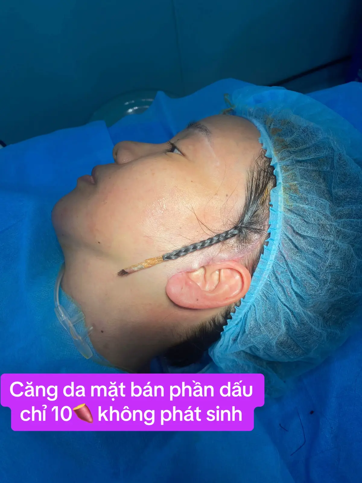 Quá mê cái đường khâu siêu đẹp  #drduyha #lamdep #pttm #xuhuong #cangda #cangdamini #cangdabanphan #cangdamat10🍠 