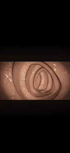 A 3d animation to show how to use snare to resect polyps in surgery.If you have interests pls contact us.#EMR #ESD  www.zrhendoscopy.com