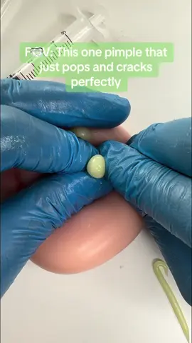 🍄🦠🍿 This one pimple that just pops and cracks perfectly. Squeezing pimples with Asmr are very satisfying videos. Follow me for more! #pimple #pimplepopper #asmr #satisfying #zit #asmrsounds #asmrvideo 