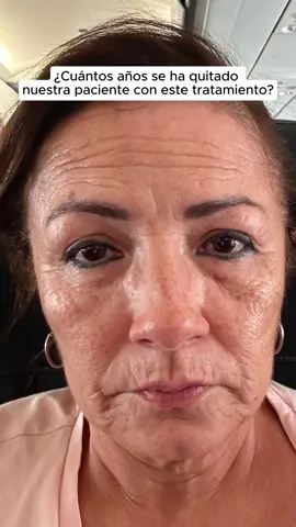 Sunekos es un tratamiento inyectable que combina ácido hialurónico y aminoácidos para rejuvenecer la piel. Ayuda a mejorar la hidratación, la elasticidad y la apariencia de la piel, promoviendo la producción de colágeno y elastina de manera natural. Sunekos estimula la producción de diferentes tipos de colágeno en la piel, lo que contribuye a su rejuvenecimiento y mejora de la estructura. Aquí te explico cómo funcionan estos tipos de colágeno: 1. **Colágeno Tipo I**: Es el colágeno más abundante en la piel y proporciona resistencia y firmeza. Sunekos ayuda a aumentar su producción, lo que resulta en una piel más firme y menos arrugas. 2. **Colágeno Tipo III**: Este tipo de colágeno es más flexible y se encuentra junto al colágeno tipo I en la piel joven. Sunekos promueve su producción para mejorar la elasticidad y la suavidad de la piel. 3. **Colágeno Tipo IV**: Este tipo de colágeno se encuentra en la membrana basal, que es la capa que separa la epidermis de la dermis. Sunekos ayuda a mantener esta estructura, mejorando la integridad y la función de la piel. 4. **Colágeno Tipo V**: Este colágeno está involucrado en la formación de fibras de colágeno tipo I y III. Sunekos ayuda a su producción, lo que contribuye a una mejor organización y cohesión de las fibras de colágeno en la piel. Al estimular estos diferentes tipos de colágeno, Sunekos no solo mejora la apariencia superficial de la piel, sino que también fortalece su estructura interna, resultando en una piel más saludable, firme y elástica. #sunekos #sunekos1200 #sunekos200 #sunekoscolombia 