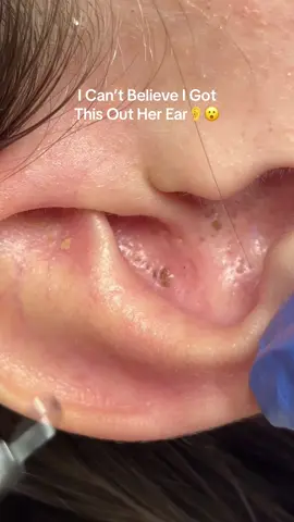 The biggest blackhead!! Check your ears!!  #blackheadremovals #blackheadextraction #blackhead #blackheadpimple #pimplepopper #facialsinlondon #londonfacials #londonfacialist #essexfacials #extractions #facialextraction #cheshuntfacials #hertfordshirefacials #hydrofaciallondon 