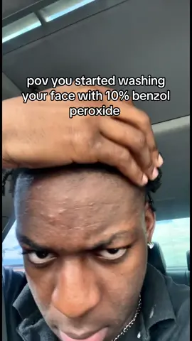free game & yes i use other products but this is what stopped my acne #skincare #acne #skincareproducts #skincareroutine #benzoylperoxide #clearskin 