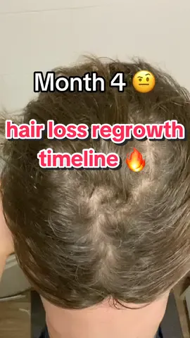 It was a big journey 😮‍💨 Follow to see everything I did to save my hair :) #hairloss #bald #hairgrowth #fyp
