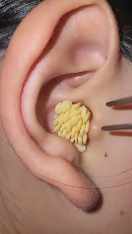 #foryou #pimple #earwaxremoval #earcleaning #