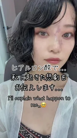 もう一生やりません🫨できません😖 #ヒアルロン酸 #韓国皮膚科 #鼻ヒアルロン酸 #韓国整形 #整形 #ヒアルロン酸注入 