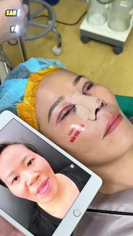 TRẢ KẾT QUẢ 7 NGÀY CHO CHỊ GÁI 44 T SAU KHI PTTM TRÙNG TU GƯƠNG MẶT#phauthuatthammy 