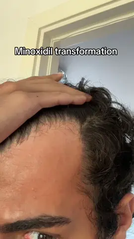 3 månader på minoxidil! Allt man behöver för att växa ut håret igen. Inga ”kits” kommer att fungera lika bra så slösa inte ens pengarna på de.  #barbernazal #frisör #kristianstad #skåne #hår #håravfall #balding #minoxidil #transformation #fade #taper #fyp #fördig #killar #män #dermaroller #hairline #growth #grow #hair 