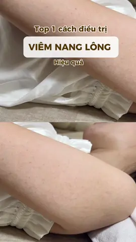 Điều trị VIÊM NAM LÔNG không còn là vấn đề khó nữa vì Ngocsu sử dụng công nghệ lăn Lactic giúp triệt tiêu tận gốc tình trạng viêm. Các bạn đừng ngần ngại và bỏ lỡ deal HOT này nha, hiện tại NgocSu đang có CTKM giảm đến 40% liệu trình VIÊM NANG LÔNG. Inbox NgocSu ngay để được tư vấn và hỗ trợ nhanh nhất nha.#ngocsubeautyclinic #ngocsuacademy #treatment #ngocsu #viemnanglong #viemlochanlong 