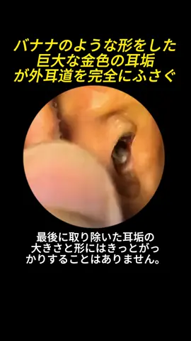 #earwax #satisfyingvideo #earwaxremoval #satisfyin #earcleaning #asmr 