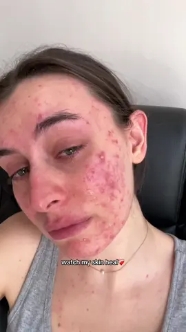 eliminare la skincare è stata la scelta migliore della mia vita❤️‍🩹 #acne #acneskin #acnefighter #acnehealingprocess #acnepositivity #acnecommunity #acnehealing 