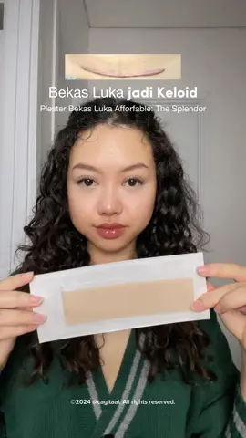 Semoga keloid pasca caesarku bisa ilang total pake silicone scar sheet @The Splendor . Penasaran banget karna so far ini plester bekas luka termurah yang aku temuin, apalagi bisa dicuci untuk dipake ulang 😍 #thesplendor #scarsheets #plesterbekasluka #keloid #bekasluka #lukapascaoperasi #lukapascamelahirkan #lukacaesar 