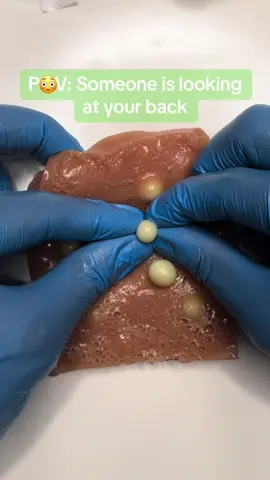 Squeezing pimples is more than satisfying! Watch me and see how satisfying it is when those pimples pop open! #pimple #pimplepopper #cyst #zit #cyst #satisfying 