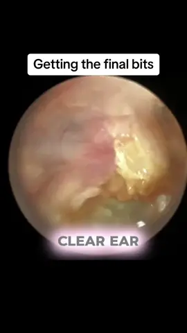 #CapCut #fyp #earwaxremoval #satisfying #earwax #earwaxcleaning #cleaning #tiktok #justforyou 