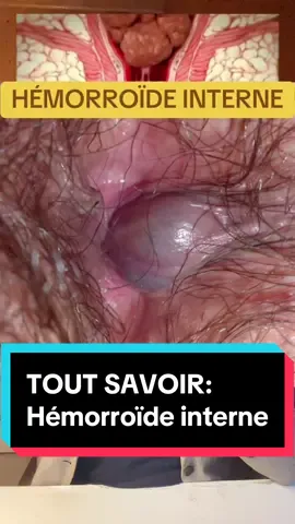 Réponse à @mariecplle Tout savoir sur l’hémorroïde interne #leopur #hemorroides #digestion 