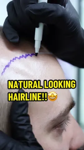DO YOU WANT A NATURAL LOOKING HAIRLINE? LOOK NO FURTHER. Hair Doctors are known for their expertise in creating natural-looking results by deliberately crafting irregular hairlines with zigzag lines. This meticulous approach is aimed at mimicking the natural hairlines of individuals, ensuring that the results are virtually undetectable.  The reason behind creating irregular and zigzag hairlines during hair transplant surgery lies in the goal of achieving the most natural appearance possible. Our hairlines are not perfectly straight and uniform, but rather have a slight irregularity and asymmetry that adds to their authenticity. By carefully designing a zigzag pattern, hair transplant doctors are able to recreate this natural look, making it incredibly challenging for anyone to discern that a hair transplant has been carried out.  This attention to detail and focus on creating a seamless transition between transplanted and existing hair follicles is what sets Hair Doctors apart in delivering natural, undetectable results for our patients. For more information contact us or send us a DM!   📍𝗖𝗢𝗡𝗧𝗔𝗖𝗧 𝗜𝗡𝗙𝗢 ▪️ www.hairdoctors.com.au ▪️ Tel (02) 7252 3351 - SYDNEY ▪️ Tel (03) 9088 0287 - MELBOURNE  ▪️ info@hairdoctors.com.au #sydney #melbourne #sydneyaustralia #melbourneaustralia #hairtransformation #hairtransplant #beforeandafter #beforeandafterhair #hairloss #hairtransplant #aussie #aussies #sydneybarber #melbournebarber #fue #recedinghairline #hairrestoration #malepatternbaldness #hairlosstreatment #hairlosshelp #hairtransplantturkey #hairtransplantistanbul #beardtransplant #alopecia #fuehairtransplant #sacekimi #hairlines #hairgrowth #hairline #baldnesssolution @Ossman Ashraf 
