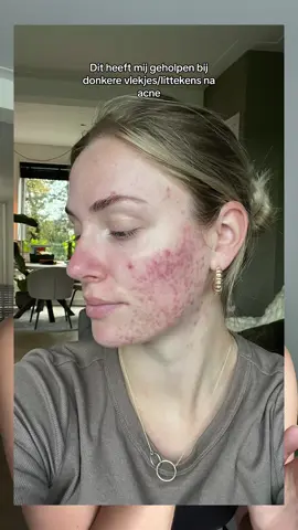 Dit heeft mij echt zo goed geholpen met de acne littekens 💕 #Eucerin #routinesforskinlikeme *ad