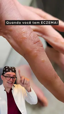 Já reparou nessas bolinhas que aparecem nos dedos? A disidrose, também chamada de eczema disidrótico, é quando surgem pequenas bolhas cheias de líquido que coçam bastante. Elas costumam aparecer nas mãos e nos pés. Ninguém sabe exatamente o que causa, mas fatores externos, como produtos de limpeza, e internos, como o estresse, podem piorar o quadro. Para tratar, é importante evitar esses gatilhos, usar cremes hidratantes e, se necessário, aplicar pomadas recomendadas pelo dermatologista. Você ou alguém que conhece já passou por isso? 🧐 #disidrose #eczema #tratamento #inflamações #mãos #dermatologista #viral