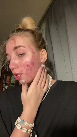my extra acc: @DARA🏄🏽‍♀️🌅🎥 I've come all this way and so can you. 🫵🏽❤️ #fyp #fypシ #acnejourney #acnefighter #acnemakeup #acne #accutane #roaccutane #cysticacne #skincare #acnebeforeafter #GlowUp #glowupchallenge #yearchallenge #oneyearchallenge 