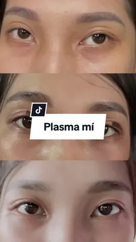 Nhớ yêu bản thân mình hơn mỗi ngày nha PLASMA NHẤN MÍ TRƯỚC KHI LÀM - SAU KHI LÀM - SAU BONG #phunxam #phunxamthammy #plasma #hairstroke #xuhuong 