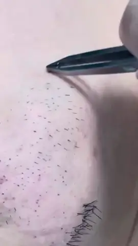 Hair removal #blackheads #pimple #hairremoval 