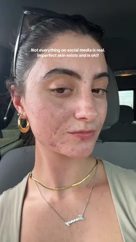 Reality check! Don’t compare yourself online!🥰 new episode coming sunday on @LoudTalk with Lavi Podcast ❤️ #skinpositivity #acnemakeup #glowyskin #acnepositivity #glowyskin #realskintexture 