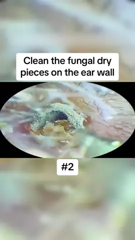 Clean the fungal dry pieces on the ear wall Part 2 #earwax #ear #earwaxing #fyp #foryou #asmr #earwash #earcleaning #earwaxcleaner #foreignbodyremoval #doctors #earwaxremoval #removing #earcleaningasmr #washing #relaxingvideos 