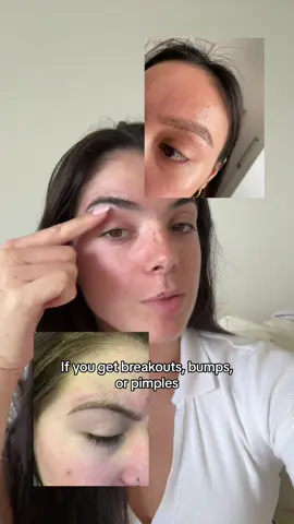 If you get breakouts bumps or pimples around your eyebrows after you wax or pluck them im going to teach you how to prevent this! #hygienetips #beautytips #femininehygiene #acnetreatment #eyebrows #eyebrowtutorial #eyebrowshaping 