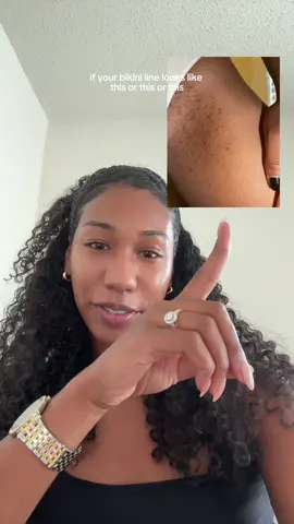 watch till the end for the life-changing hack to glow up your bikini line! #kojic #kojicsoap #kojicacid #skincaretips #bikinilineroutine #ingrown 