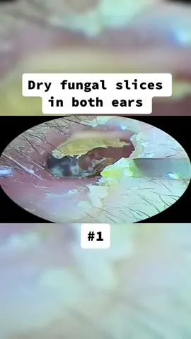Dry fungal slices in both ears Part 1 #earwax #ear #earwaxing #fyp #foryou #asmr #earwash #earcleaning #earwaxcleaner #foreignbodyremoval #doctors #earwaxremoval #removing #earcleaningasmr #washing #relaxingvideos 