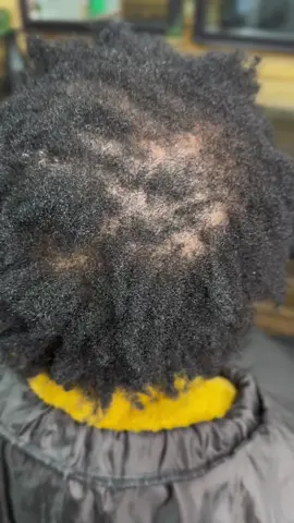 Alopecia areata occurs when the immune system attacks hair follicles and may be brought on by severe stress. 🍂 ✨Alopecia areata is NOT caused by a poor diet or lack of vitamins. ✨Can be triggered by stress, depression, anxiety, and any other mental health-related issues.  ✨Can be caused by a hereditary predisposition.  ✨Alopecia areata is incurable but may be treated. ✨ If the hair loss is spotty, there is a considerable likelihood that complete regrowth will occur without the use of any treatment although, there may be further hair loss incidents in the future.  Are suffering from Alopecia?💆🏽‍♀️ Kindly contact our Certified Hair Loss Consultant: 0817971289.📲☎️ Call/WhatsApp  To know more about Alopecia, visit our Hair Care Blog: www.afrotexture.co.za (link on bio) 🌎👩🏽‍💻 #afrotexture #afrotexturesa #afrotexturehairtreatmentspa #nonoshaircare #certifiedhairlossspecialist #hairconsultant #alopecia #alopeciaareata #alopeciaawareness #nonoshaircareblog #fyp #beautykzn #newcastlekzn #viralreels #foryou #explore #explorepage✨ 