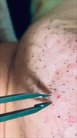 Hair removal ❤️ @INILLEROM  #hairremoval #pimple #blackheads 