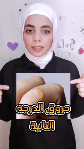 #الاسعافات _الاولية _للحروق #حروق_الدرجة_التانية_ _ #first_aid_for_burns  #viral_video  #nurse 