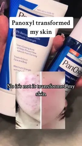 If you suffer with cystic/hormonal acne anywhere on your face or back you definitely need to try this facewash its been avaialble in amercia for ages and all the dermatologists rave and reccomend it and you can finally get it in the uk the benzoyl peroxide 10% will change your skin but make sure you read the instructions and use it correctly otherwise it wont work!! #benzoylperoxide #panoxylfacewash #panoxyl #acneproneskin #acnetreatment #acnefacialwash #dermatologistrecommended #clearskintips #clearskinjourney #cysticacne #backacne 