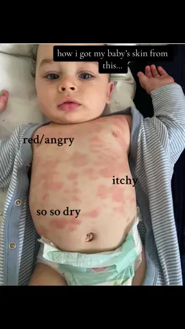#babyeczema #baby #skintransformation #eczema #babytiktok #fyp #aveeno #babyaveeno #firsttimemom @aveenobabyus @Aveeno @AVEENO® Baby UK & Ireland 🤎🤍