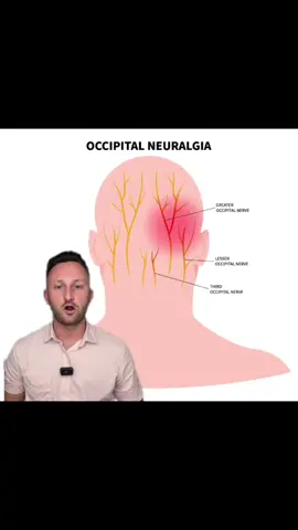 Occipital Neuralgia 😱 Pounding, burning, aching feeling in the back of your head?  This pain can feel like a migraine or headache that causes intense pain in the occipital region Upper cervical care can help!  #occipitalneuralgia #headache #burning #aching #headachesarasota #occipitalneuralgiasarasota 