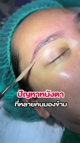 ชั้นตาชัดโดยไม่ต้องทำตา👀 แถมการมองเห็นดีขึ้น✨ #อาจารย์เฟิร์นfernclinic #อาจารย์เฟิร์นจึ้งจิตจึ้งใจ  #หมอเฟิร์น #หมอเฟิร์นจึ้งจิตจึ้งใจ #หมอเฟิร์นขี้อวด #สวยพุ่งจนต้องแชร์ #fernclinic #subbrowlift #subbrowliftปรับชั้นตา #subbrowliftตัดหนังตาส่วนเกิน #ทำตาที่ไหนดี #คลีนิคหมอเฟิร์น #lessscartechnique #เทคนิคซ่อนไหม #เทคนิคซ่อนไหมไร้รอยแผล #หนังตาตก #หนังตาหย่อน #fernaesthetiqueclinic #เปลี่ยนแปลงตัวเอง #ยกคิ้ว #ยกหางตา #แปลงร่าง #หน้าอ่อนวัย #หน้าเด็ก #หน้ามีอายุ #รีวิวบิวตี้ #ยกคิ้ว #ยกคิ้วบน #ตาสดใส #หน้าเศร้า #ยกหางตา #ยกคิ้ว #รีวิวศัลยกรรม #ซับบราวลิฟท์ #tiktoklook#tiktokuni #tiktokพาดู #tiktokป้ายยา #ชั้นตาชัด #คนไทยรู้ทัน #TikTokกินเที่ยว @หมอเฟิร์น Fern Clinic 