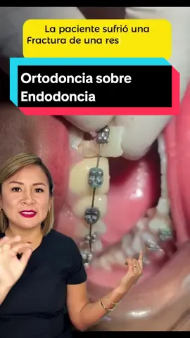 ¿Tratamiento de conductos con brackets? 😬 ¡Ups, un problema! Consulta a un especialista para resolverlo y mantener tu sonrisa en buen camino. 🦷✨ #dúo con @Dr. Donosoo    📥Escríbenos vía inbox https://linktr.ee/clinicasonrisasegura Web: https://www.clinicasonrisasegura.pe/ TikTok: clinicasonrisasegura Twitter: sonrisa_segura #Endodoncia #Ortodoncia #Brackets #SaludDental #CuidadoBucal #SonrisaSegura #Viral
