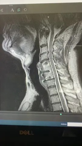 On MRI, what does a herniated disk look like in thr neck? Find out here!! #HerniatedDisk   #CervicalSpine   #SpineHealth   #MRIScan   #BackPain   #NeckPain   #SpinalCare   #MedicalImaging   #HealthEducation   #Radiology   #SpinalInjury   #Anatomy   #MedicalKnowledge   #Healthcare   #Wellness   #PhysicalTherapy   #SpineAnatomy   #Neuroscience   #Chiropractic   #PainRelief   #SpinalHealth   #DiskHerniation   #MRI   #MedicalInsight   #HealthAwareness   #NeckInjury   #SpineCare   #Ortho   #NeuroHealth   #PatientEducation   #MedicalFacts   #Wellbeing   #HealthTips   #SpineWellness   #Orthopedic   #NeckCare   #Radiologist   #SpinalWellness   #PainManagement   #ChronicPain 